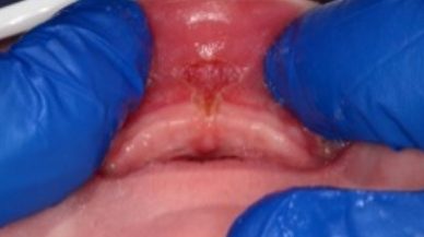 Closeup of lip tie patient after procedure