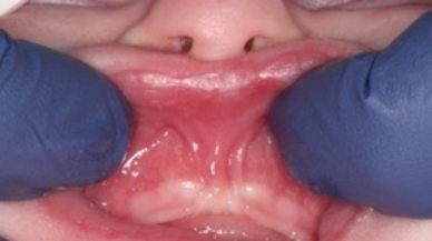 Image of lip tie patient before frenectomy