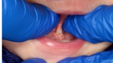 Tongue-Tie patient one week after procedure