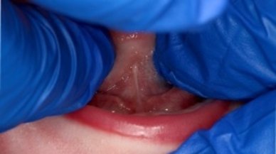 Closeup of Tongue-Tie patient before treatment
