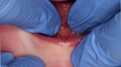 Image of Tongue-Tie patient after procedure