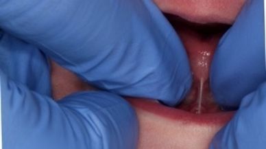 Image of Tongue-Tie patient before procedure