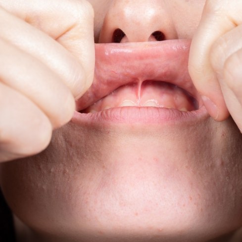 Closeup of patient in need of LightScalpel laser frenectomy