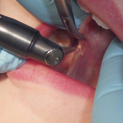 Patient receiving laser frenectomy treatment