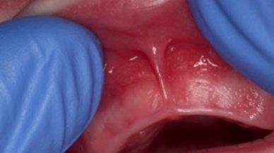 Closeup of lip tie patient before treatment