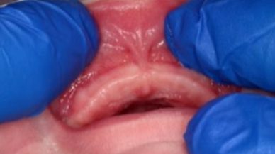 Closeup of lip tie patient before procedure