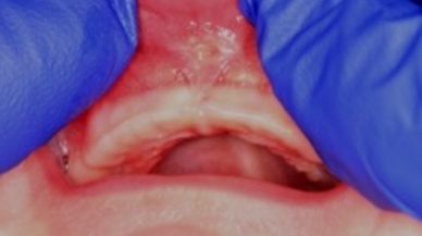 Closeup of lip tie patient one week after procedure