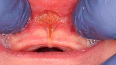 Closeup of lip tie patient after frenectomy