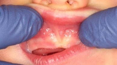 Closeup of lip tie patient before frenectomy
