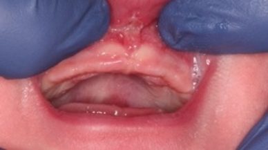 Closeup of lip tie patient one week after frenectomy
