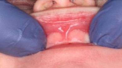 Lip tie patient before treatment