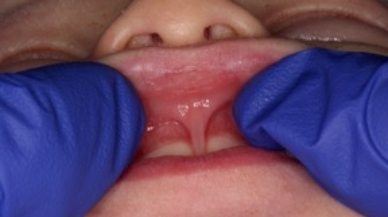 Lip tie patient before frenectomy