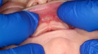 Lip tie patient one week after frenectomy