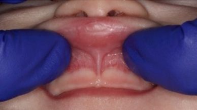 Lip tie patient before procedure