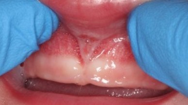 Lip tie patient one week after procedure