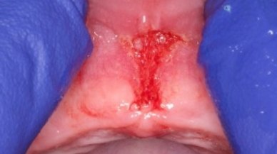 Image of lip tie patient after procedure