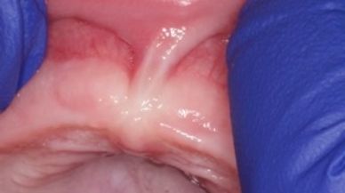 Image of lip tie patient before procedure