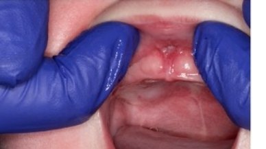 Image of lip tie patient one week after procedure