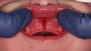 Image of lip tie patient after treatment