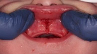 Image of lip tie patient after treatment