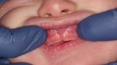 Image of lip tie patient before treatment
