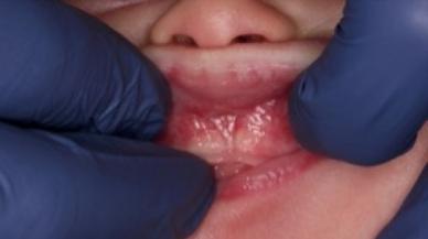 Image of lip tie patient one week after treatment