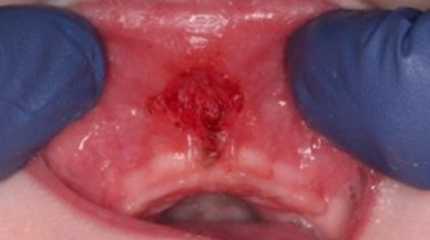 Image of lip tie patient after frenectomy