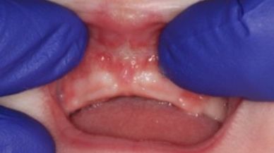 Image of lip tie treatment one week after frenectomy
