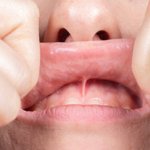 Closeup of child with lip tie