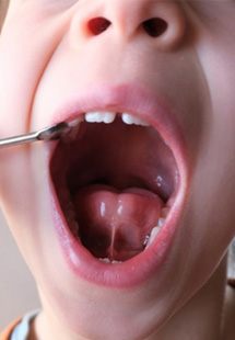 a child requiring tongue tie treatment near Glen Ellyn