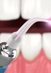 a 3 D illustration of a lightscalpel laser for frenectomy