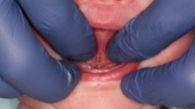 Tongue-Tie patient after treatment