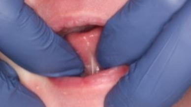 Tongue-Tie patient before treatment