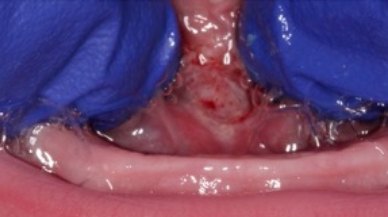 Post treatment image of Tongue-Tie patient