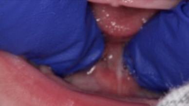 Pretreatment image of Tongue-Tie patient