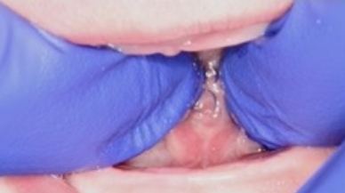 One week post treatment image of Tongue-Tie patient