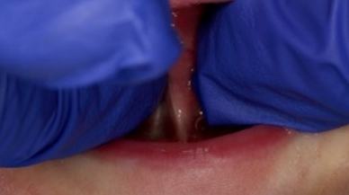 Tongue-Tie patient before procedure