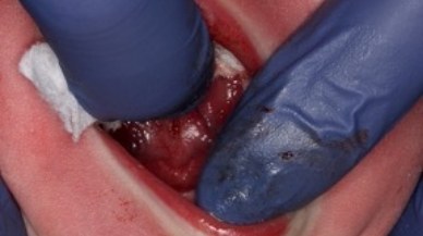 Tongue-Tie patient after frenectomy