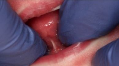 Tongue-Tie patient before frenectomy