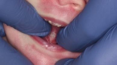 Tongue-Tie patient one week after frenectomy