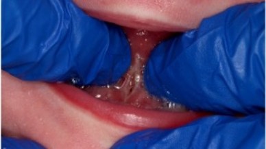 Closeup of Tongue-Tie patient after treatment