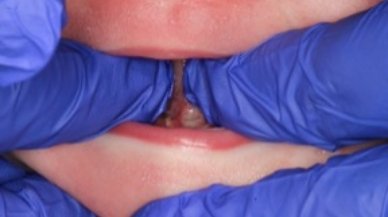 Closeup of Tongue-Tie patient one week after treatment