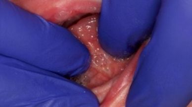 Closeup of Tongue-Tie patient after procedure