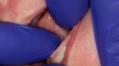 Closeup of Tongue-Tie patient before procedure