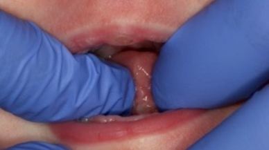 Closeup of Tongue-Tie patient one week after treatment