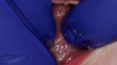 Closeup of Tongue-Tie patient after frenectomy