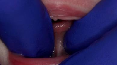 Closeup of Tongue-Tie patient before frenectomy