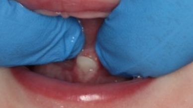 Closeup of Tongue-Tie patient one week after frenectomy