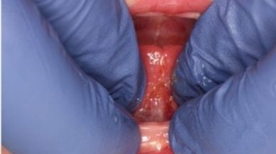 Image of Tongue-Tie patient after treatment