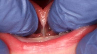 Image of Tongue-Tie patient before treatment
